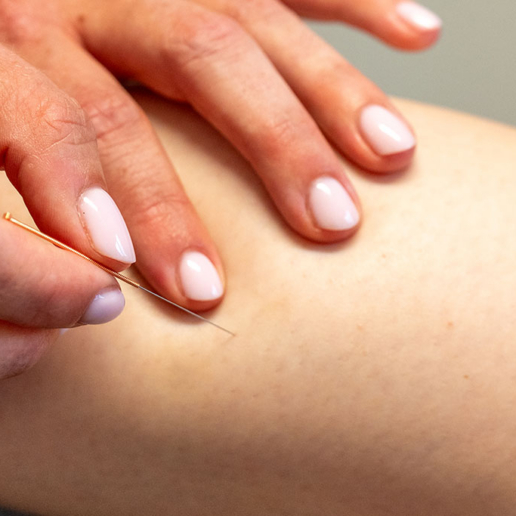 Reflow: Dry Needling